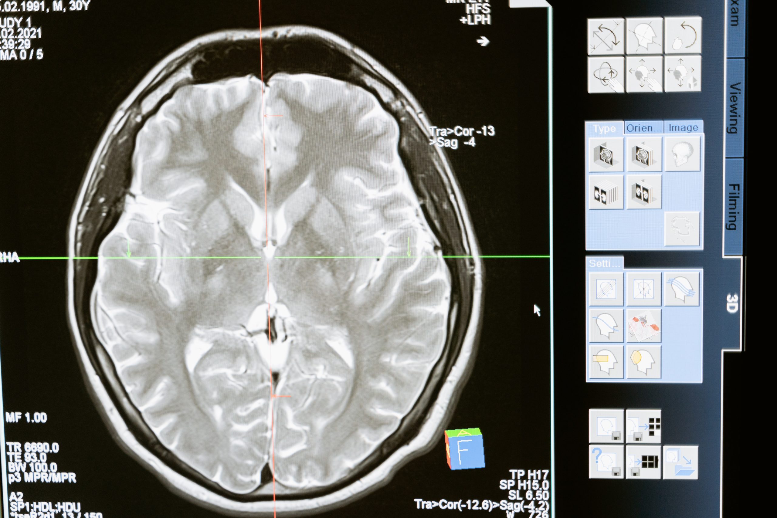 An image of a brain scan appears on a computer screen.